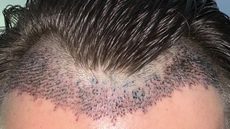 How to Deal With Shock Loss after an FUE Hair Transplant?